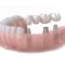 Implantologia dentale Valsamoggia presso Dentosan