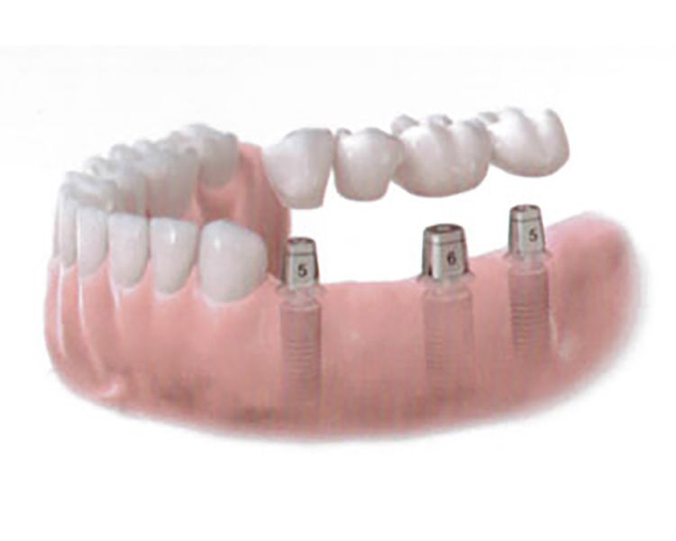 Implantologia dentale Valsamoggia presso Dentosan