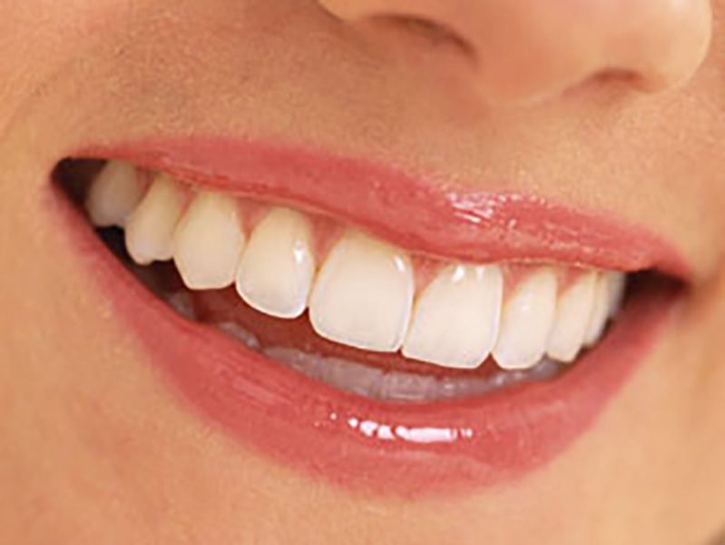 Sbiancamento denti: come funziona