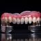 Protesi su impianti dentali perché sceglierle quale tipologia è migliore